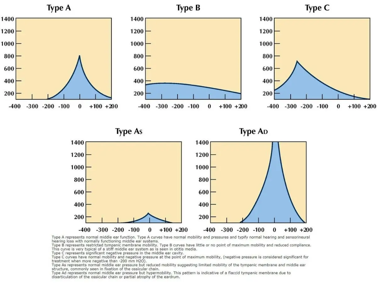 Tympanometry Test Results